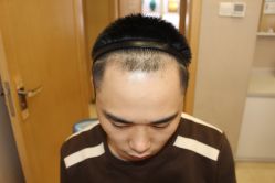 -大麦微针植发丨全国连锁