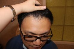 -大麦微针植发丨全国连锁