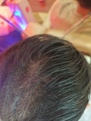 -碧莲盛·不剃发植发