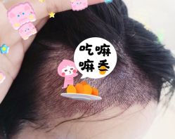 -大麦微针植发全国连锁