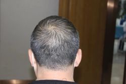 -大麦微针植发全国连锁