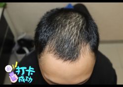 -大麦微针植发全国连锁