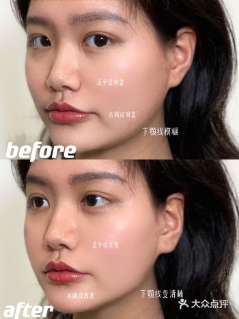 变美日记-Fotona 4D Pro加强版体验干货分享