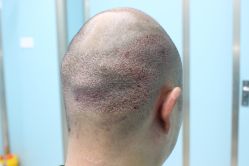 点击看大图 -大麦微针植发丨全国连锁