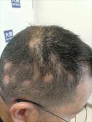 点击看大图 体验前-大麦微针植发丨全国连锁