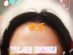 -大麦微针植发全国连锁