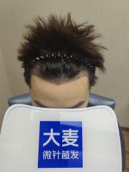 -大麦微针植发全国连锁