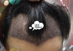 -大麦微针植发全国连锁