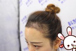 -大麦微针植发丨全国连锁