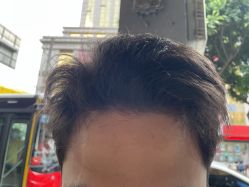 -大麦微针植发全国连锁