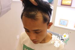 -大麦微针植发全国连锁