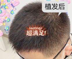 -大麦微针植发全国连锁