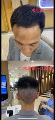 -大麦微针植发全国连锁