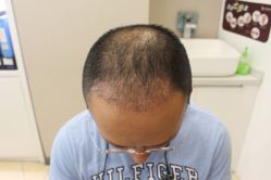 点击看大图 -大麦微针植发丨全国连锁