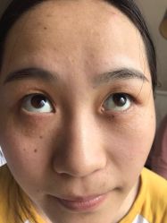 -美丽人生祛斑扁平疣汗管瘤中心