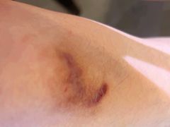 -杭州仁易堂中医康复医院疤痕修复