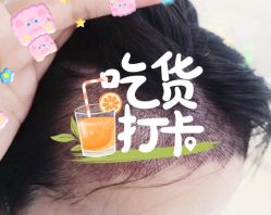 -大麦微针植发全国连锁