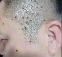 -北京美痣堂古方祛痣斑疣瘊