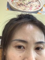 体验后-北京英煌医疗美容