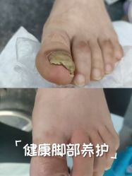 -德哥灰指甲脚气甲沟炎跖疣护理