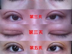 漏掉了第四天，可惜了-上海华安整形外科门诊部