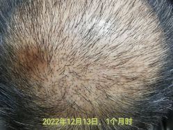 点击看大图 体验后-大麦微针植发丨全国连锁