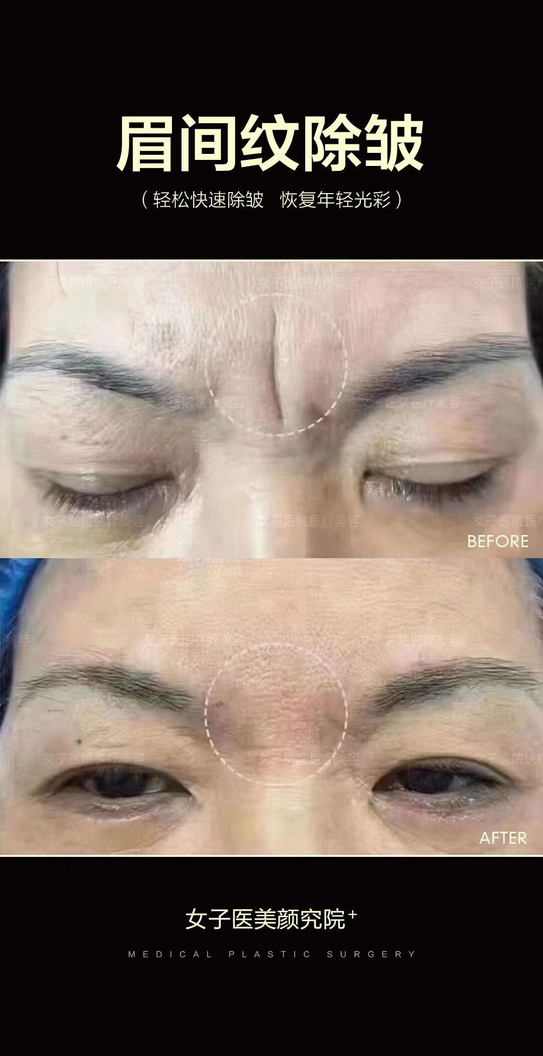 眉间纹除皱前后对比