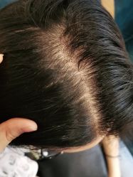 -碧莲盛·不剃发植发