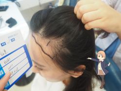 -大麦微针植发丨全国连锁