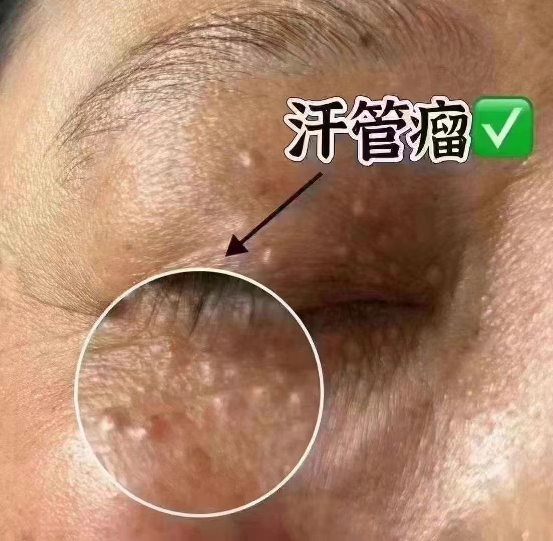 🇨🇳汗管瘤其实它是一种慢性病,由于汗