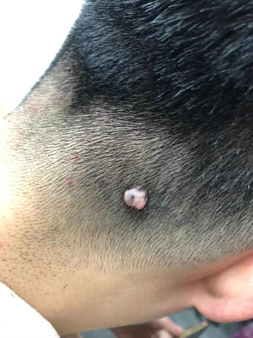 从小就有的大瘊子,想看恢复好后的照片可以联系我