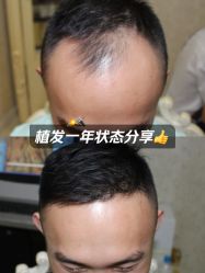 -大麦微针植发全国连锁
