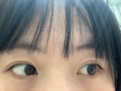 -黑马眼科·近视手术