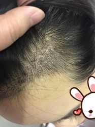 -大麦微针植发丨全国连锁