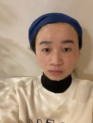 体验后-针美汇欧邦医疗美容