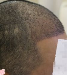 -大麦微针植发丨全国连锁