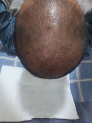 -碧莲盛·不剃发植发