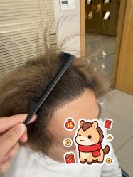 -大麦微针植发丨全国连锁