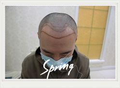 -大麦微针植发全国连锁