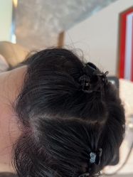 -碧莲盛·不剃发植发