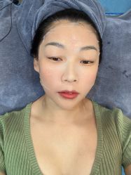 体验后-More摩尔医美の注射线雕光电中心