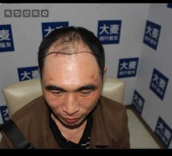 体验前-大麦微针植发丨全国连锁