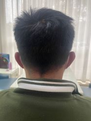 -大麦微针植发丨全国连锁