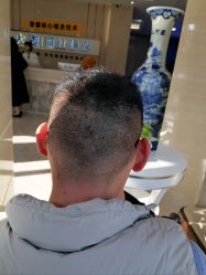 体验后-大麦微针植发丨全国连锁