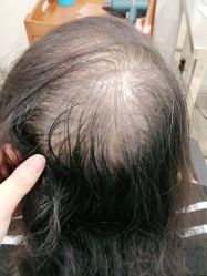 -碧莲盛·不剃发植发