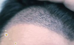 -大麦微针植发丨全国连锁
