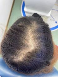 -大麦微针植发全国连锁