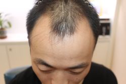 -大麦微针植发丨全国连锁