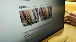 -碧莲盛·不剃发植发