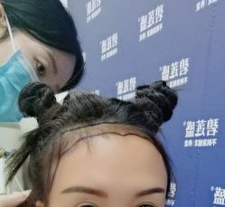 -碧莲盛·不剃发植发